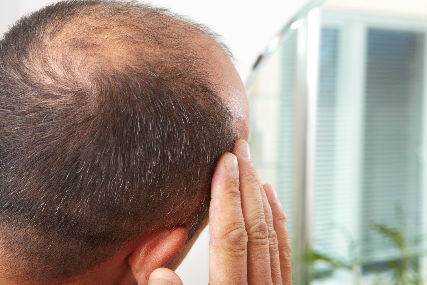 3 Things You Can Do To Stop Baldness