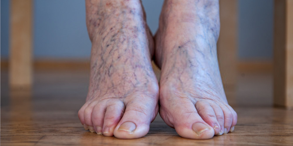 Are Varicose Veins Dangerous? What Your Doctor Wants You to Know